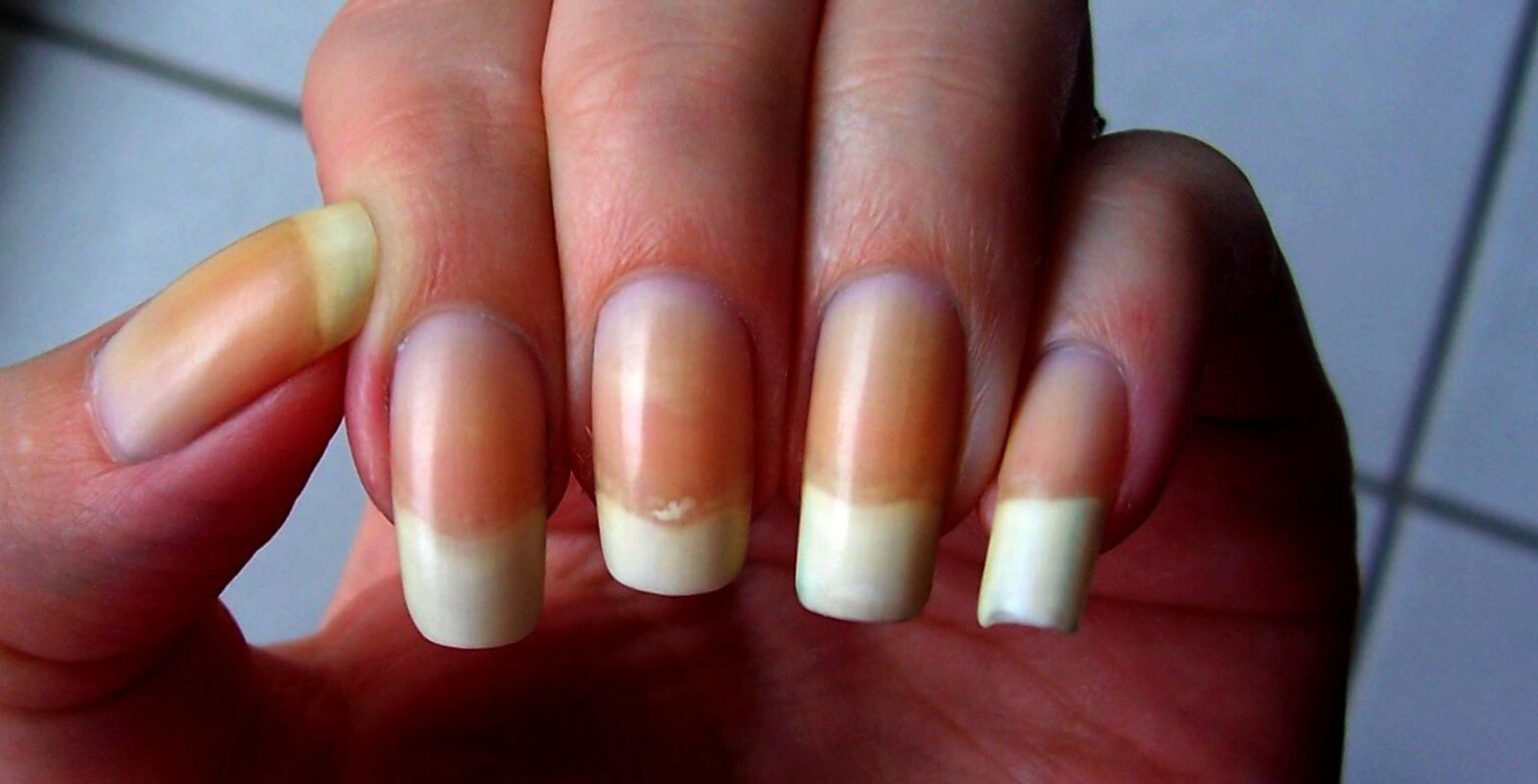 Ongles jaunes ? C’est forcément l’un de ces problèmes de santé