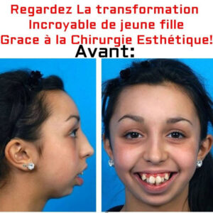 INCROYABLE changement d’une jeune fille Grace à la Chirurgie Esthétique